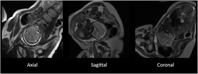 Semi-automatic segmentation of the fetal brain from magnetic resonance imaging